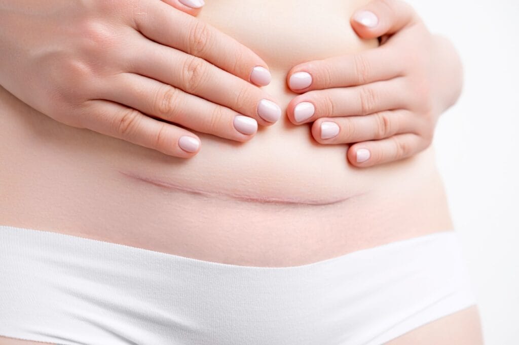 recuperare după cezariană, detaliu cu chilot postnatal pentru protecția inciziei