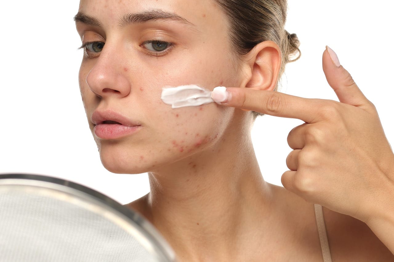 Cea mai bună Cremă pentru acnee