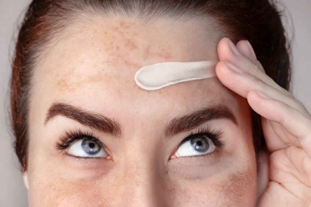 Femeie cu hiperpigmentare folosind cremă depigmentantă, evidențiind cercetările actuale în estomparea petelor